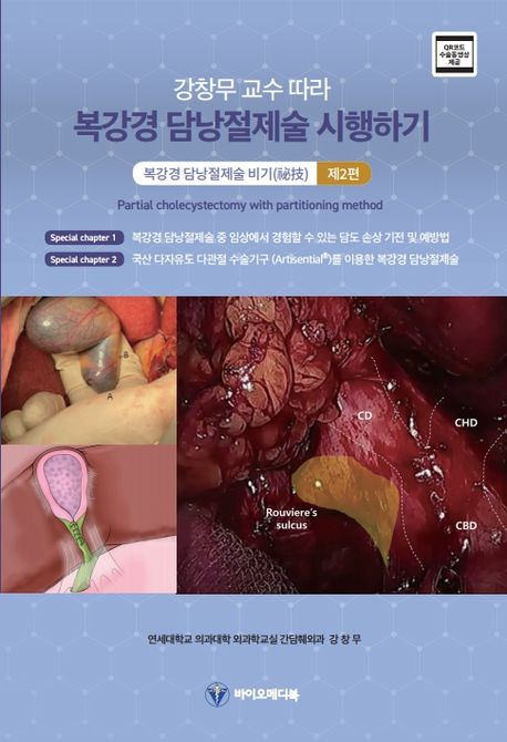 강창무 교수 따라 복강경 담낭절제술 시행하기 제2편-복강경 담낭절제술 비기